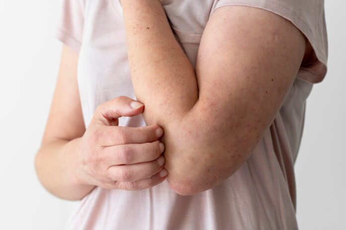 Mulher com alergia na pele do braço